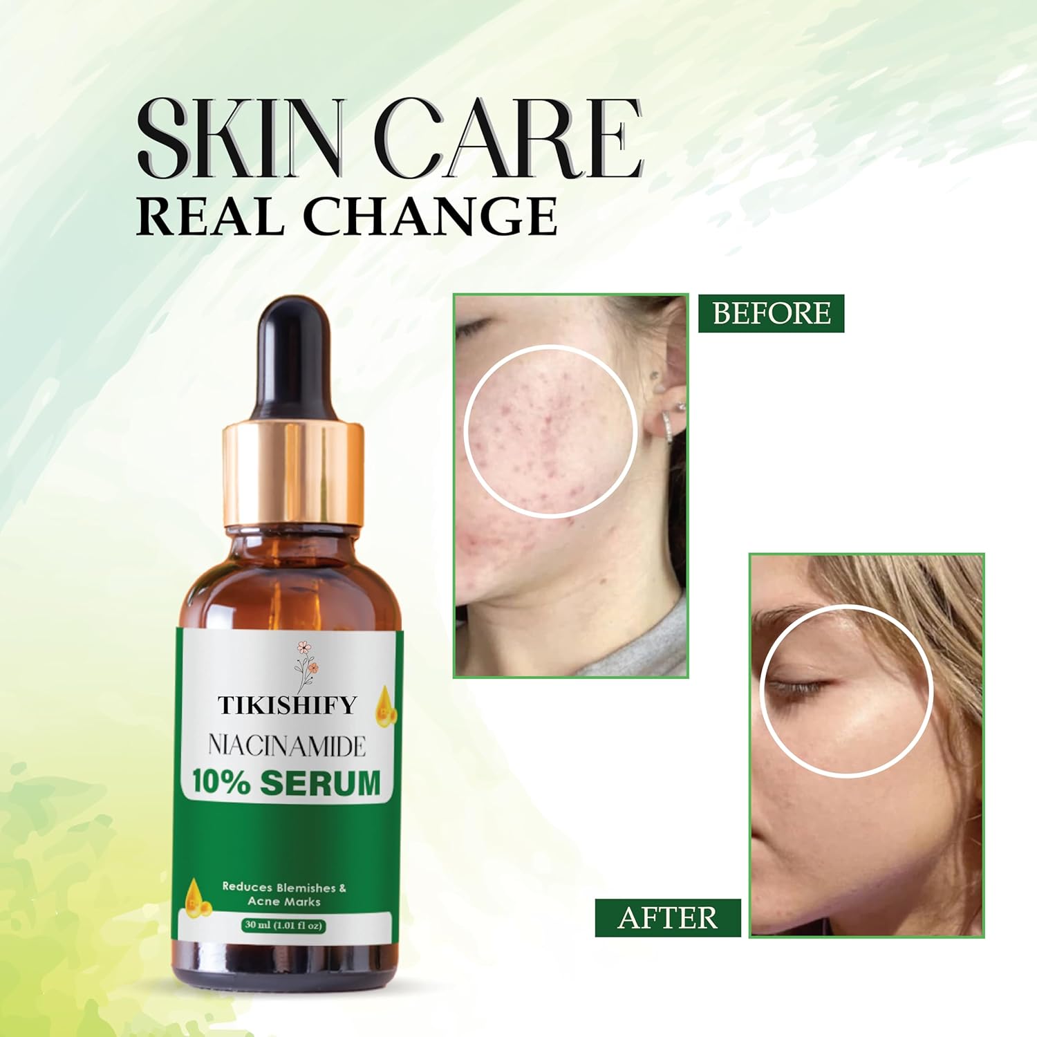 Niacinamide 10% Serum, Reduces Blemishes & Acne Marks, 30ml (1.01 fl oz)